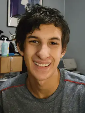 Instant Smile Veneer (Upper Only) photo review