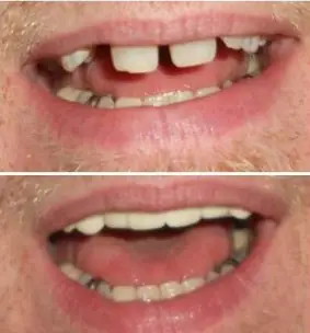 Instant Smile Veneer (Lower Only) photo review