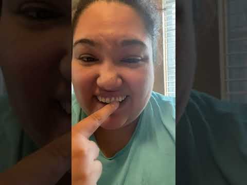 Instant Smile Teeth Veneer Review for Upper Veneer