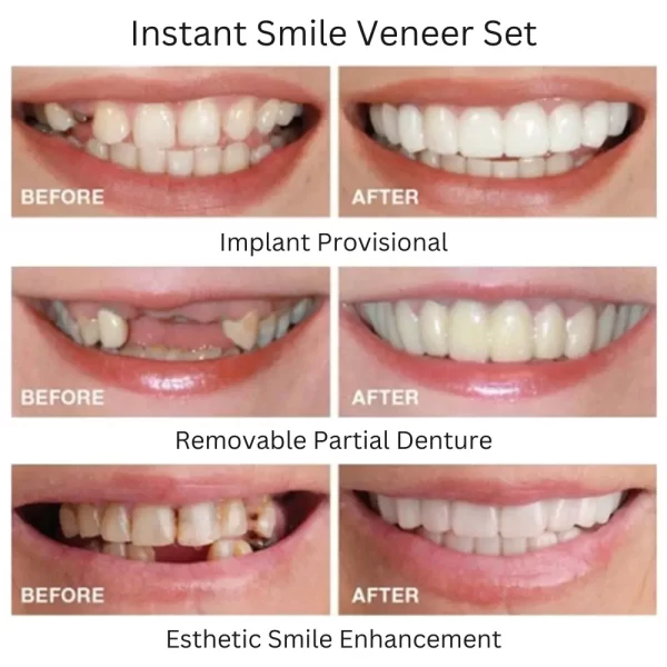 Instant Smile Teeth Veneers Benefits