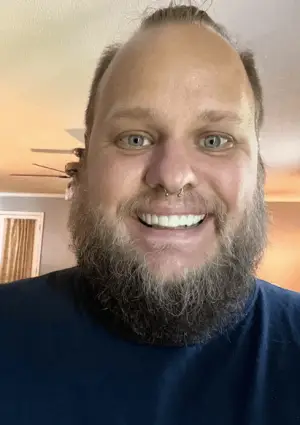 Instant Smile Veneer (Upper Only) photo review