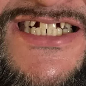 Instant Smile Snap On Veneers (Upper & Lower) Smile Teeth Veneers photo review