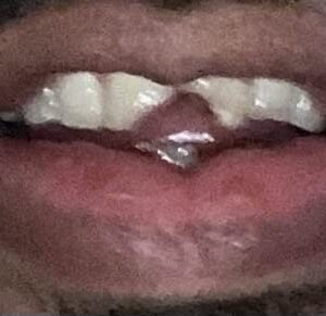 Instant Smile Veneer (Upper Only) photo review