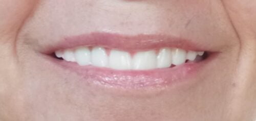 Instant Smile Veneer (Upper Only) photo review