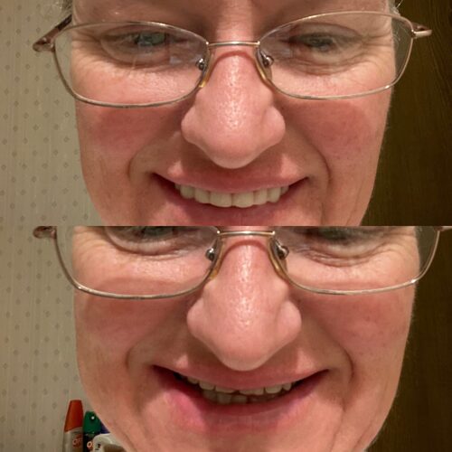 Instant Smile Veneer (Upper Only) photo review