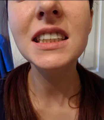 Invisible Teeth Retainer - 3 Stages Straightening Orthodontic Set photo review