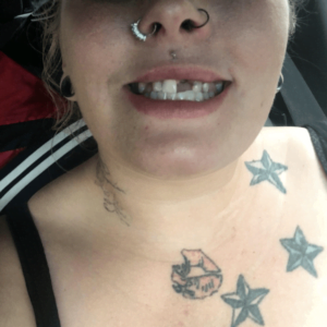 Keely Rae - Instant Smile Teeth Veneers Customer Review Before