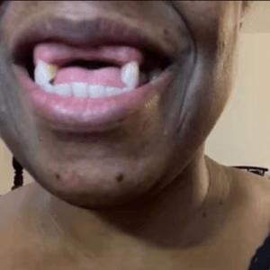 Marcus Before Instant Smile Review